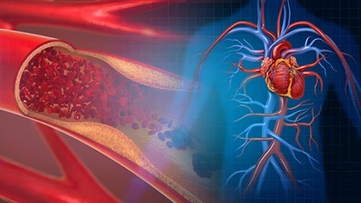Aort damarı yırtılması nedir? Aort yırtılması belirtileri
